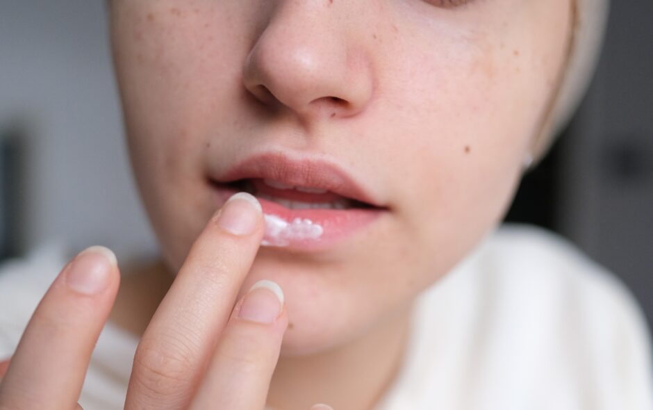 How Long After Dissolving Lip Filler Can You Refill?